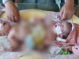 Siamské dvojčatá spod Tatier čaká zlomová operácia. Oddelia ich na prestížnej klinike v Saudskej Arábii