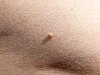 Malé kožné výrastky vyzerajú nevinne. Dermatologička varuje pred ich domácim odstraňovaním