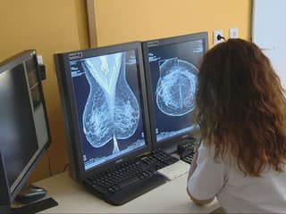 Veľká zmena pre onkologických pacientov. Čaká ich nový systém liečby