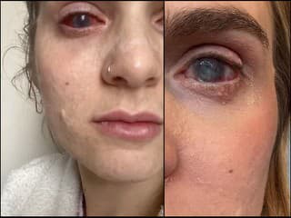 Jaqueline si vzala populárny liek proti bolesti: Skončila v kóme a po 26 operáciách oslepla! DESIVÉ FOTO