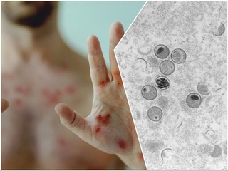 Ďalšie znepokojivé správy z Ruska: Po obávanom more riešia ďalšie vážne ochorenie! Prví pacienti sú v izolácii