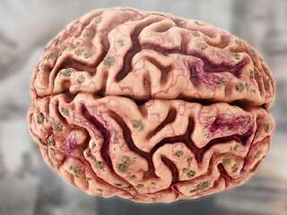 Vedci upravili vitamín K a v mozgu spustili zvláštny proces. Môže ukázať cestu k liečbe Alzheimera