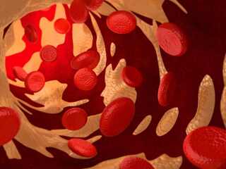 Jednorazová experimentálna liečba znížila zlý cholesterol. Účinok pretrval aj po roku