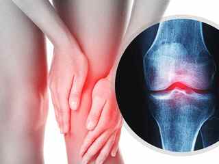 Bolí ťa koleno? Táto častá reakcia môže osteoartrózu ešte zhoršiť