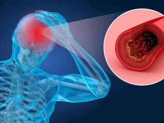 Magnetická tekutina, ktorú lekári podajú priamo do srdca, môže zastaviť mŕtvicu ešte skôr, než vznikne