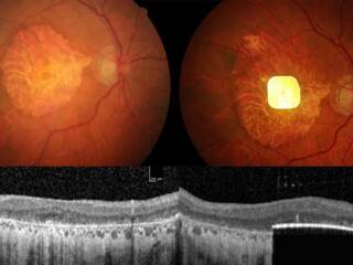 Malý očný implantát s umelou inteligenciou pomáha ľuďom s poškodeným zrakom opäť vidieť