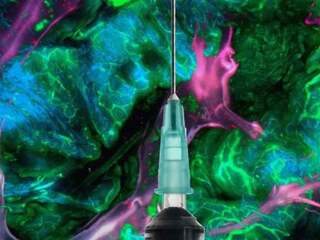 mRNA vakcína proti rakovine si udržala účinok aj po piatich rokoch, hovoria Moderna a Merck