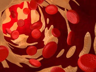 Jednorazová experimentálna liečba znížila zlý cholesterol. Účinok pretrval aj po roku