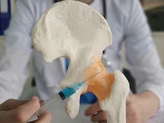Koxartróza je extrémne častá: Takýto je pohľad západnej i tradičnej medicíny na liečbu