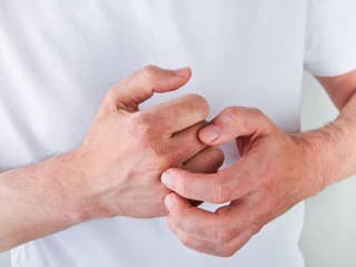 Zimná vyrážka nie je ekzém: Takto sa jej zbavíte v krátkom čase