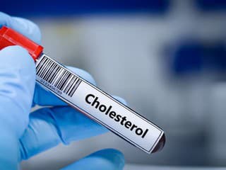 Skrytý cholesterol môže až štvornásobne zvýšiť riziko infarktu. Lekári odporúčajú jednoduchý test