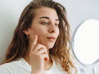 Máte akné a neviete prečo? Dermatológovia upozorňujú na niekoľko prekvapivých príčin