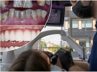 Zubné implantáty zmenia život: Prinavrátia sebavedomie a najmä zdravie