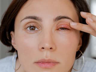 Jačmeň v oku: Je to naozaj iba estetický problém? Toto hovorí o vašom zdraví