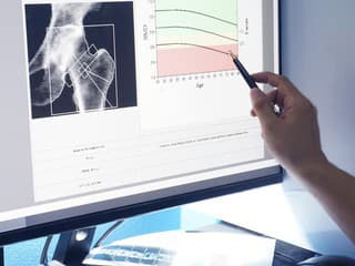 Menopauza a osteoporóza: Prečo po 50tke výrazne rastie riziko rednutia kostí a čo s tým