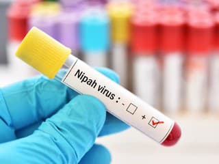 Vírus Nipah má už na konte prvú mŕtvu: Hrozí niečo aj nám?