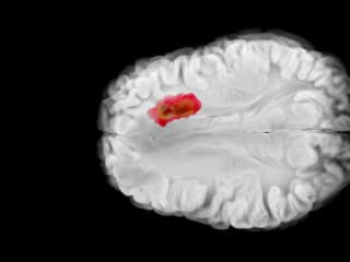 Na Slovensku každý rok pribúdajú pacienti s nádorom na mozgu: Musia bojovať s množstvom problémov, o ktorých netušíme