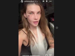 Známa Slovenka po mesiaci doma z liečebne: Odretá tvár, zranená ruka a VIDEO, z ktorého mrazí!