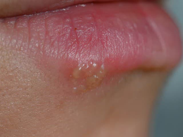 Herpes na pere nie je len kozmetický problém: Treba ho liečiť, ale týmto „babským radám‟ radšej neverte!