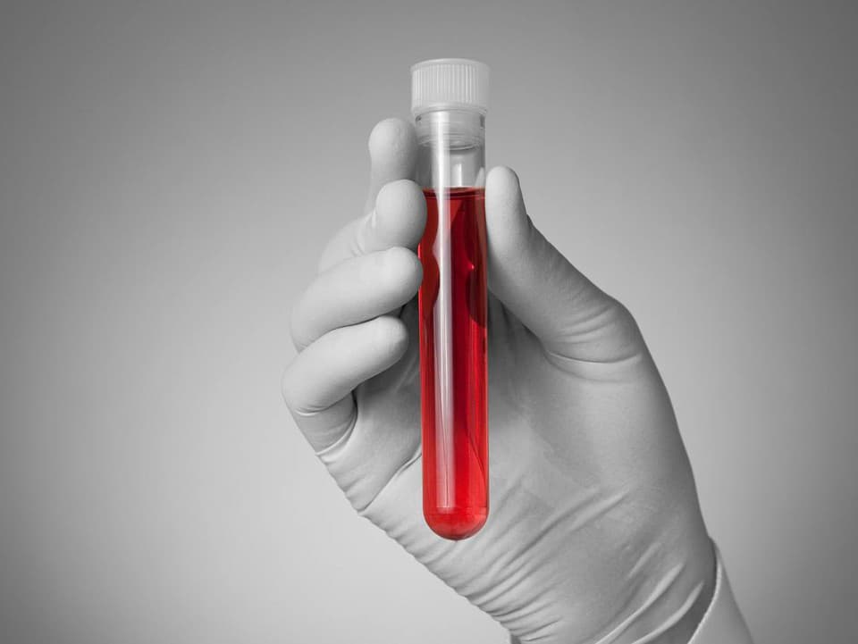 Nový AI krvný test dokáže odhaliť riziko infarktu či mŕtvice až 15 rokov vopred