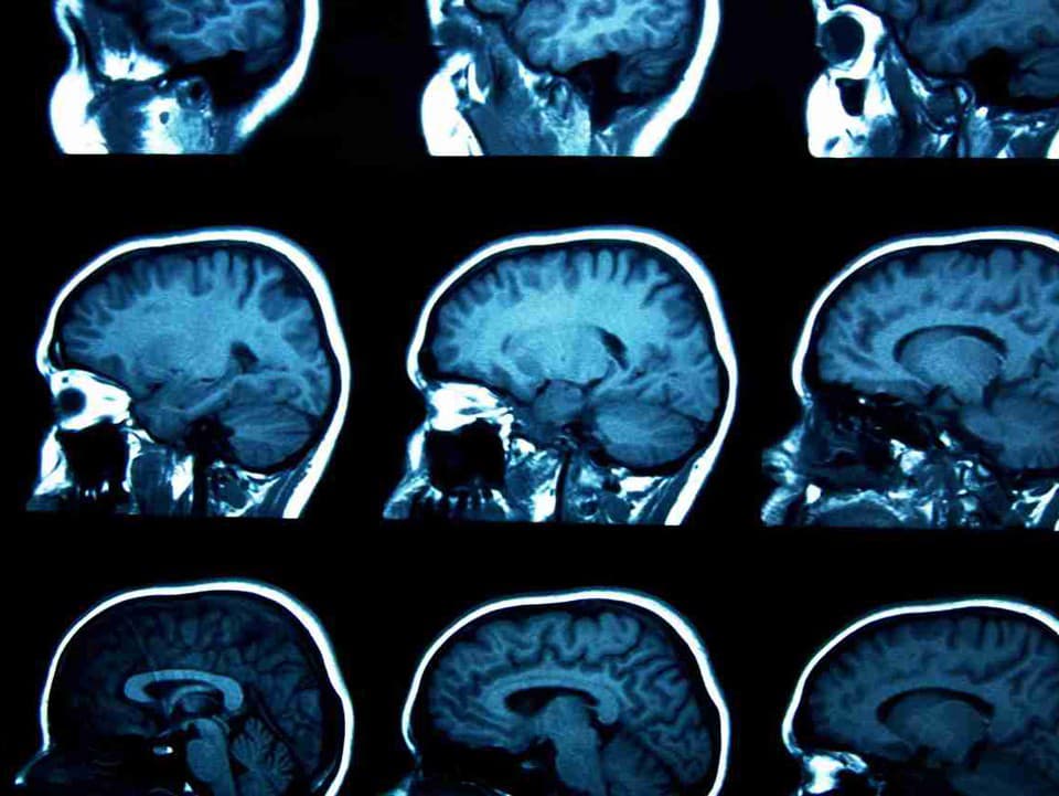 AI od Mety sa priblížila k čítaniu myšlienok. Dokáže to bez implantátu aj bez operácie mozgu