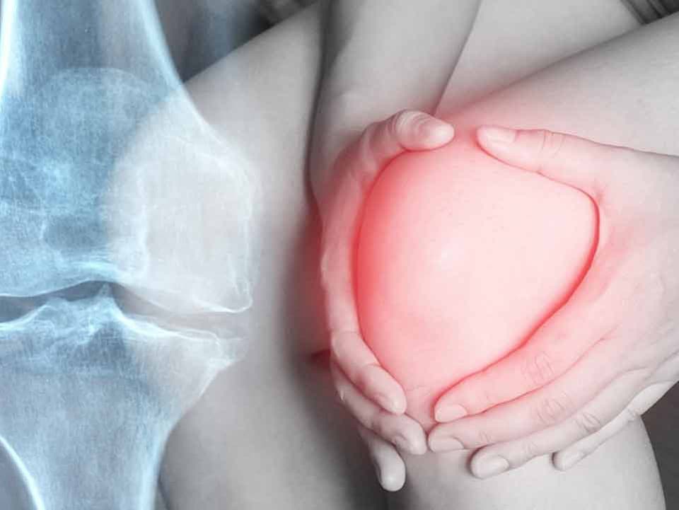 Vedci našli jednoduchý spôsob, ktorý môže zmierniť bolesť pri artróze kolena. Má ho doma množstvo ľudí
