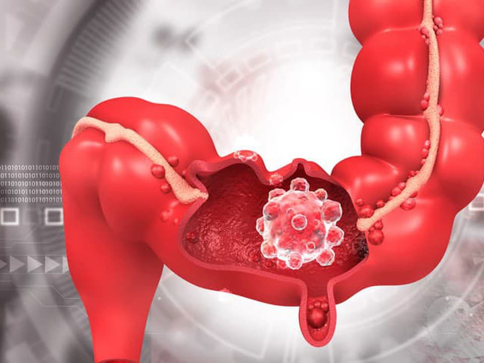 Rakovina hrubého čreva u mladších dospelých prudko stúpa: Toto sú príčiny, upozorňujú vedci