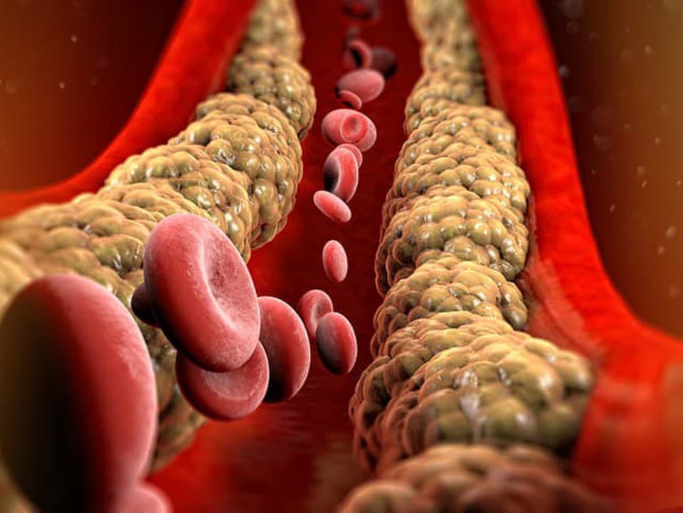Trápi vás vysoký cholesterol a bolesti kĺbov? TENTO domáci sirup to zmení