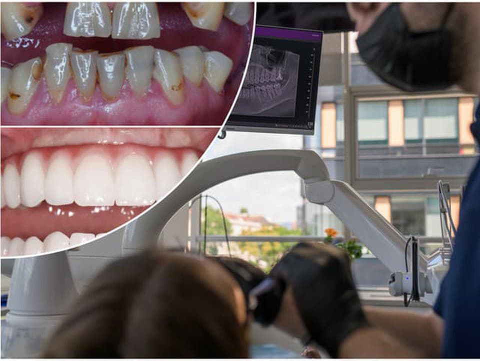 Zubné implantáty zmenia život: Prinavrátia sebavedomie a najmä zdravie