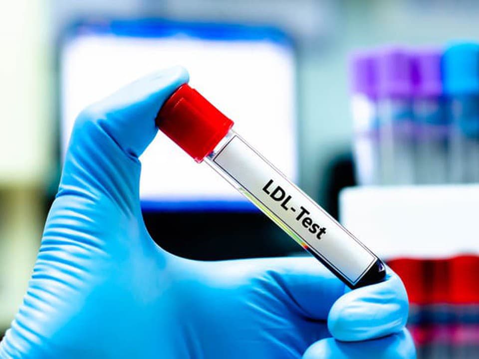 Prečo sa cholesterol zhoršuje aj u ľudí, ktorí nejedia veľa tuku