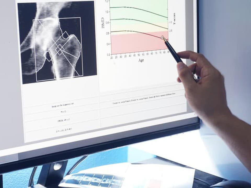 Menopauza a osteoporóza: Prečo po 50tke výrazne rastie riziko rednutia kostí a čo s tým