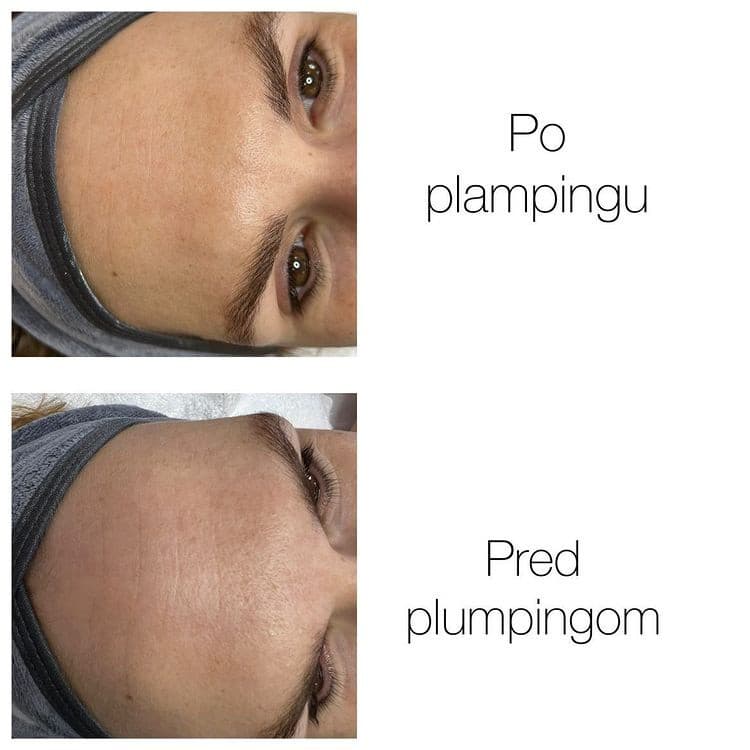 Plumping je neinvazívne ošetrenie