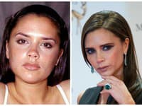 Victoria Beckham si nechala okrem poprsia upraviť aj nos