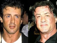 Sylvester Stallone pred a po plastike