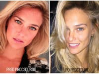 Bar Rafaeli sa po blestivom zákroku vôbec nezmenila, čo poviete?