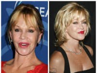Tvár Melanie Griffith je tiež poznačená plastikami