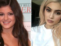 Kylie Jenner roky klamala o zväčšení svojich pier
