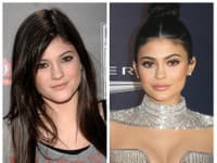 Modelka Kylie Jenner pred a po zákrokoch