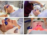 Softlifting je minimálne invazívne ošetrenie, pri ktorom sa pomocou mezoterapie a vysokovýkonného intenzívneho pulzného svetla (IPL) revitalizuje, hydratatuje a omladzuje pokožku