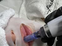 Plumpingom dokážeme na pleti vyriešiť všetky nedokonalosti