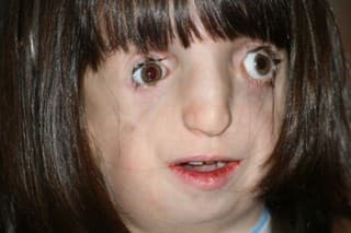 Treacher Collins syndrom: Deti,
