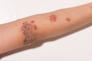Impetigo: Pripomína rozškriabané štípance,