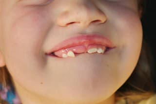 Loose Tooth