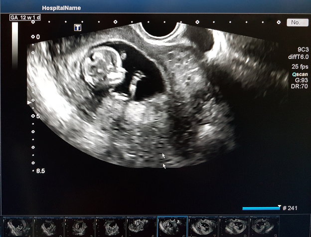 Ako čítať tehotenský ultrazvuk?