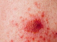 Rakovina kože. Foto: Gettyimages.com