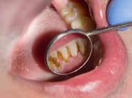 Ako ODSTRÁNIŤ zubný KAMEŇ bez lekára? S TÝMTO treba počítať, zabráňte jeho TVORBE!