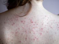 TOTO je 8 príčin akné na chrbte