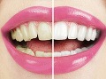 Vyskúšali ste už bielenie zubov? Dôverovali by ste domácim receptom alebo by ste radšej zašli k zubárovi? 