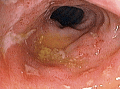 Pohľad na zvredovatelé ileum tenkého čreva 42-ročnej pacientky s Crohnovou chorobou.