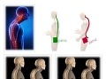 Ak sedíme dlhšie pri počítači, bolesti nemusíme vnímať. Pritom nás môžu trápiť poruchy držania tela: predsunuté držanie hlavy a zaguľatený chrbát, vybočenie hrudnej chrbtice, šikmé postavenie panvy.   
